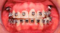 boca con microtornillos puestos